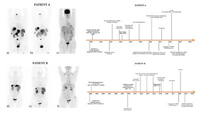 68Ga-DOTATOC PET/CT-Based Radiomic Analysis and PRRT Outcome: A Preliminary Evaluation Based on an Exploratory Radiomic Analysis on Two Patients